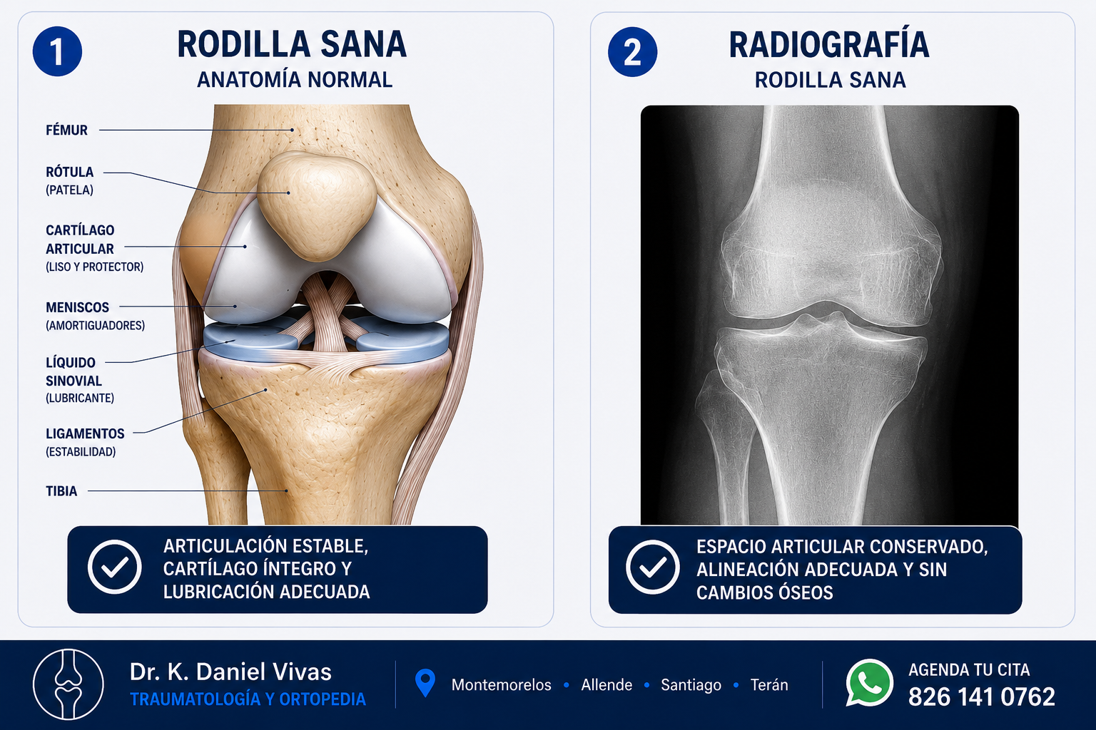 Anatomía de la rodilla sana, con lesión y radiografía normal