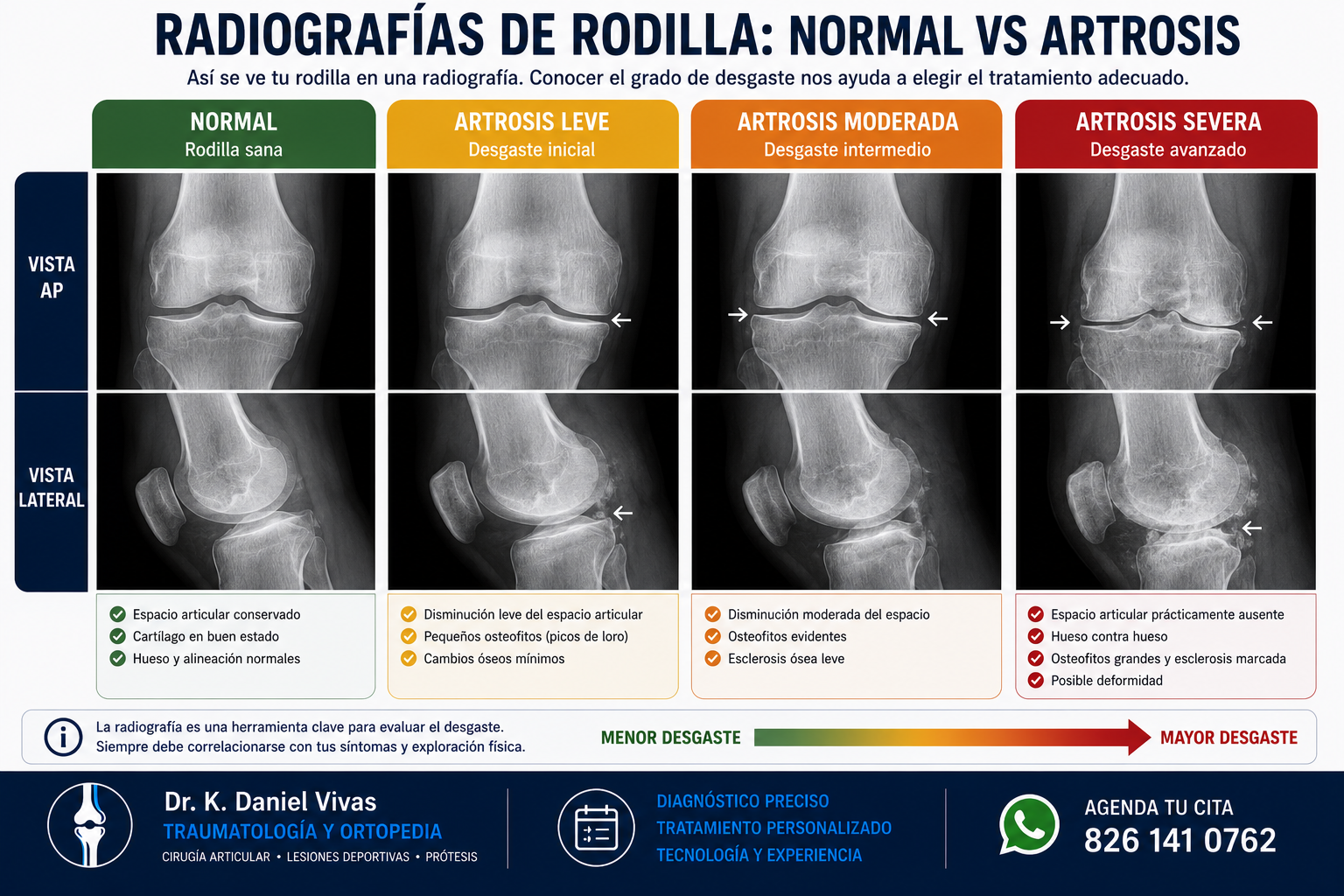 Comparación de radiografías de rodilla sana vs con artrosis