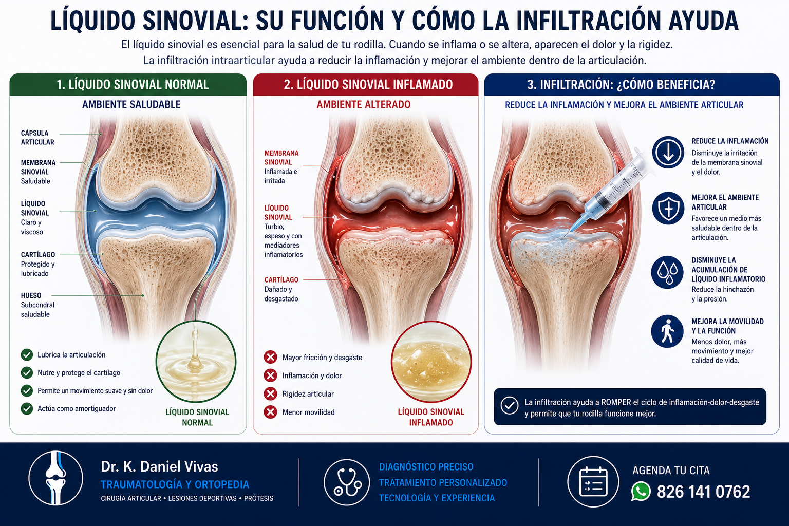 Líquido sinovial: cómo se daña con la artrosis
